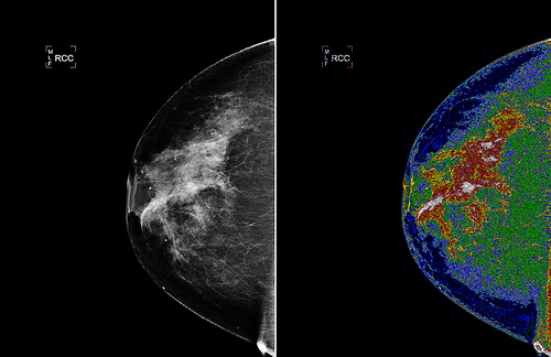 Najlepšia zbraň na rakovinu prsníka u žien (nie mamograf)